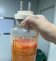 淮滨水动力吸脂手术要做多久？